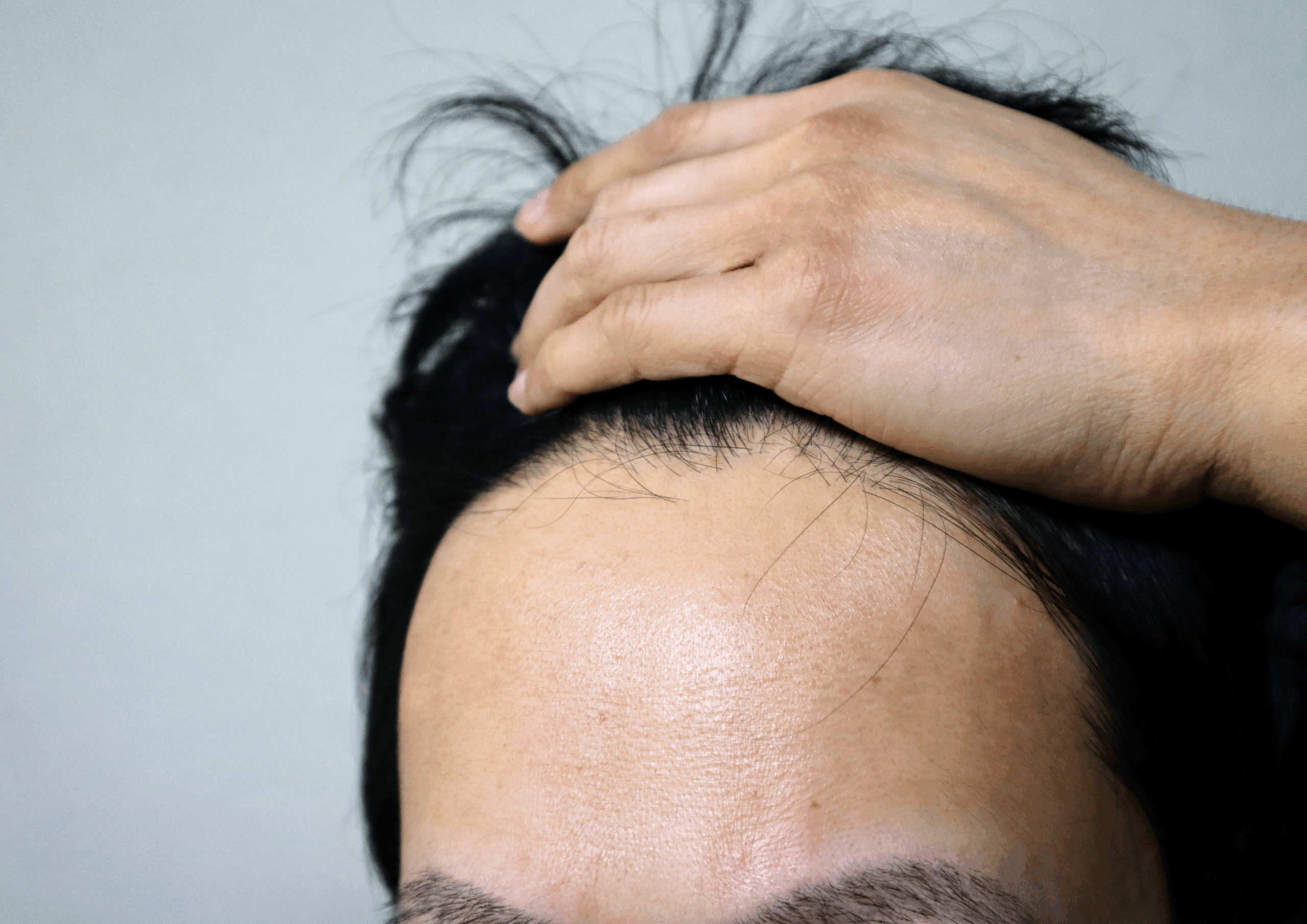 AGAの遺伝的要因のイメージ