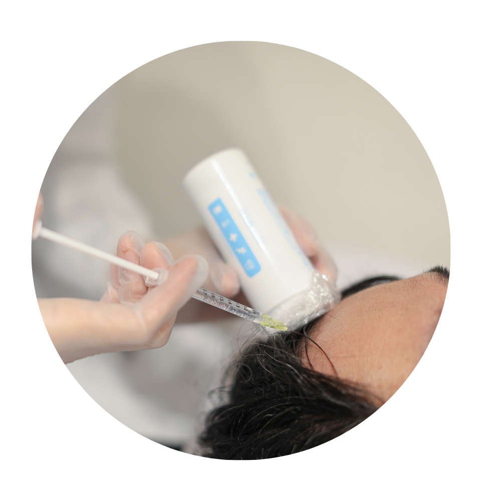 発毛プランより効果的な発毛メソセラピー