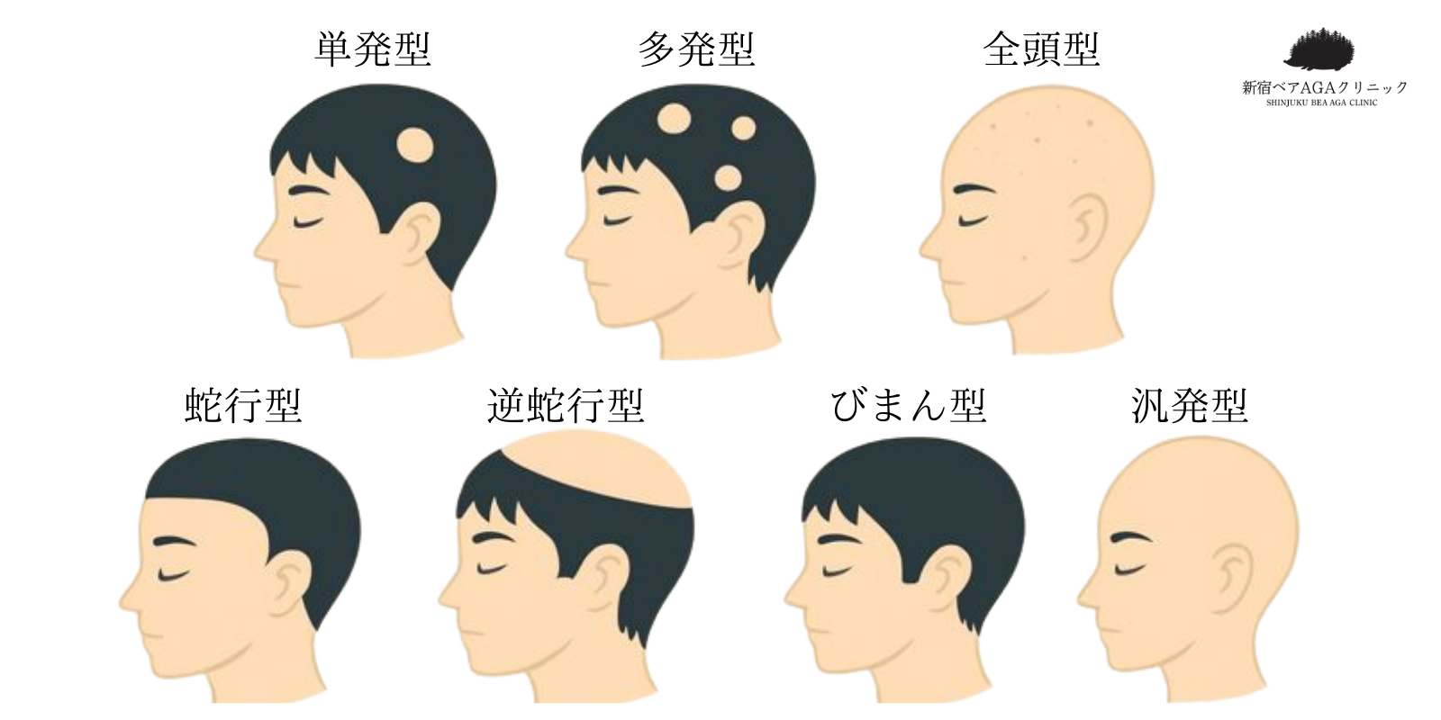 円形脱毛症の代表的なパターン図（単発型・多発型・全頭型・汎発型・蛇行型・逆蛇行型・びまん型など）