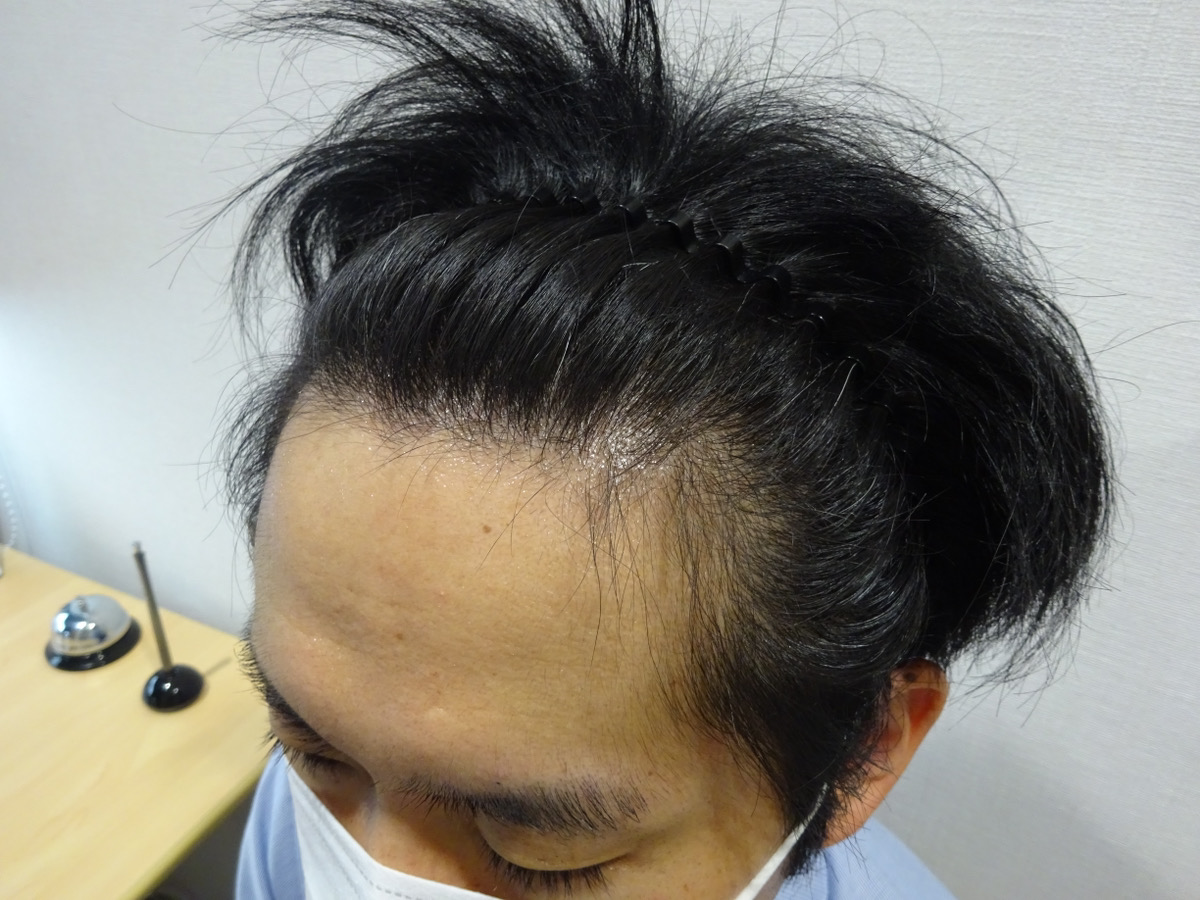 治療後
