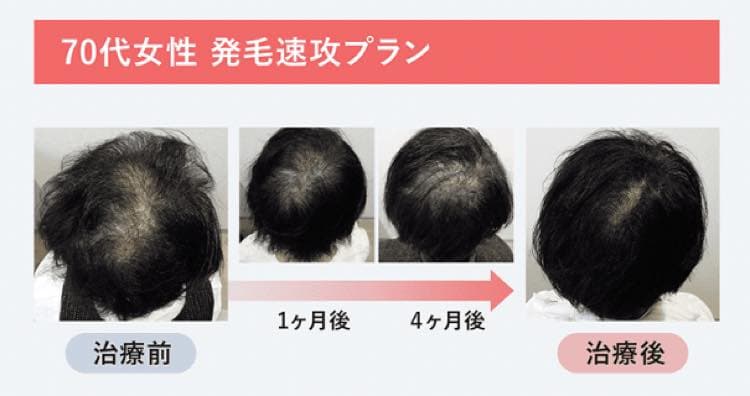 70代女性発毛即効プラン|4ヶ月後のビフォーアフター