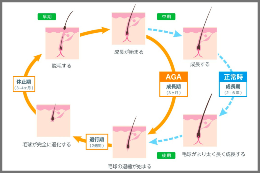 ヘアサイクルの図。正常時は成長期が2〜6年続くが、AGAでは成長期が約3ヶ月に短縮し、退行期（約2週間）・休止期（3〜4ヶ月）を経て脱毛する