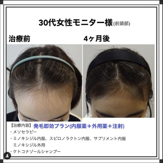 体験談 30代女性 前頭部