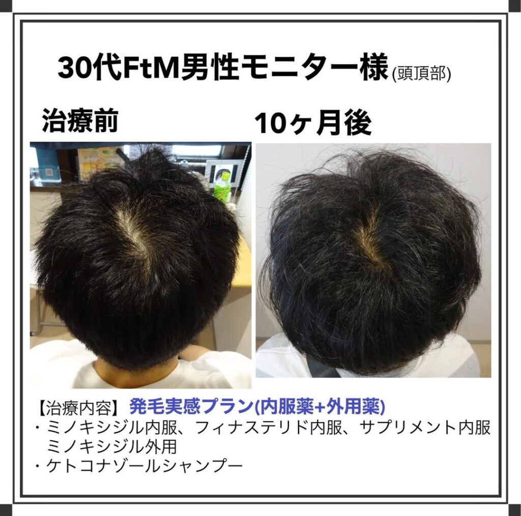 30代FtM男性 発毛プラン