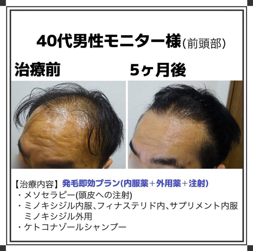 40代男性 発毛プラン