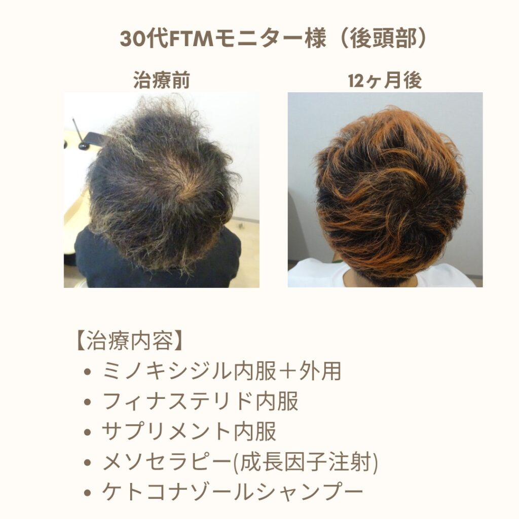 30代FTM男性 発毛プラン