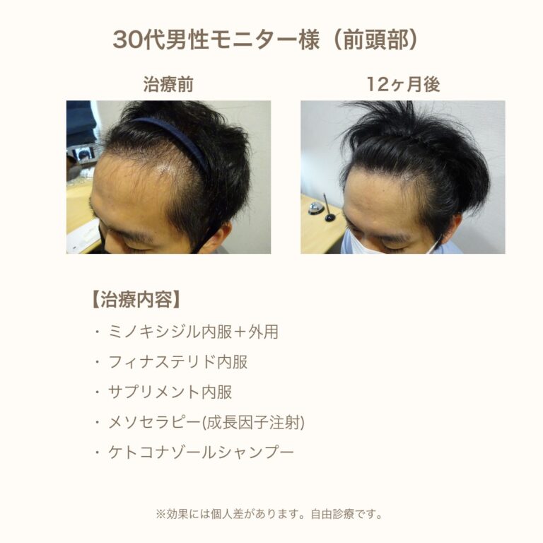 30代男性 生え際(前頭部)の発毛症例の治療前後